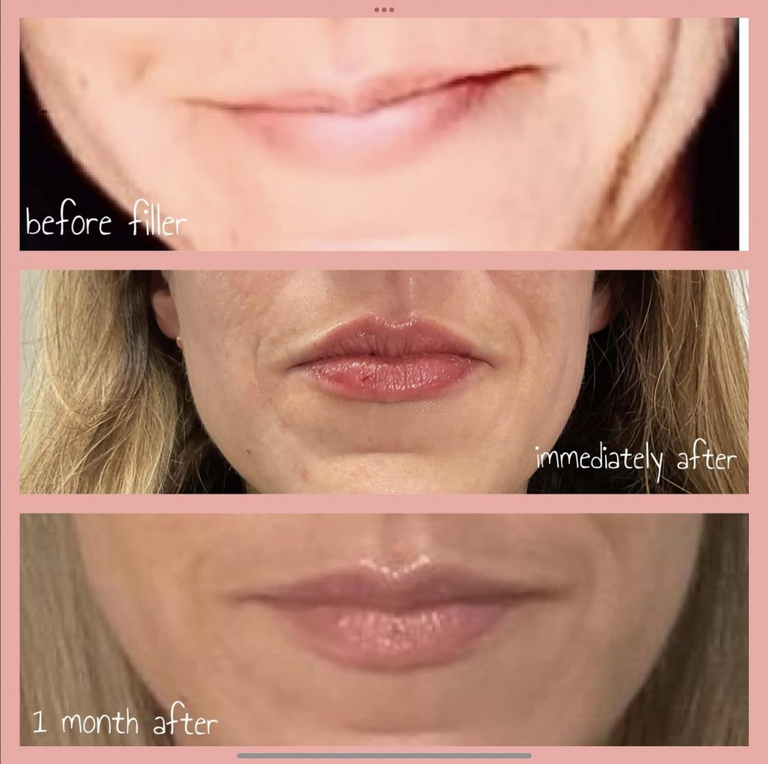 1 ml Vobella LIP FILLER