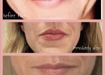 1 ml Vobella LIP FILLER