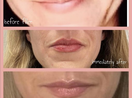 1 ml Vobella LIP FILLER