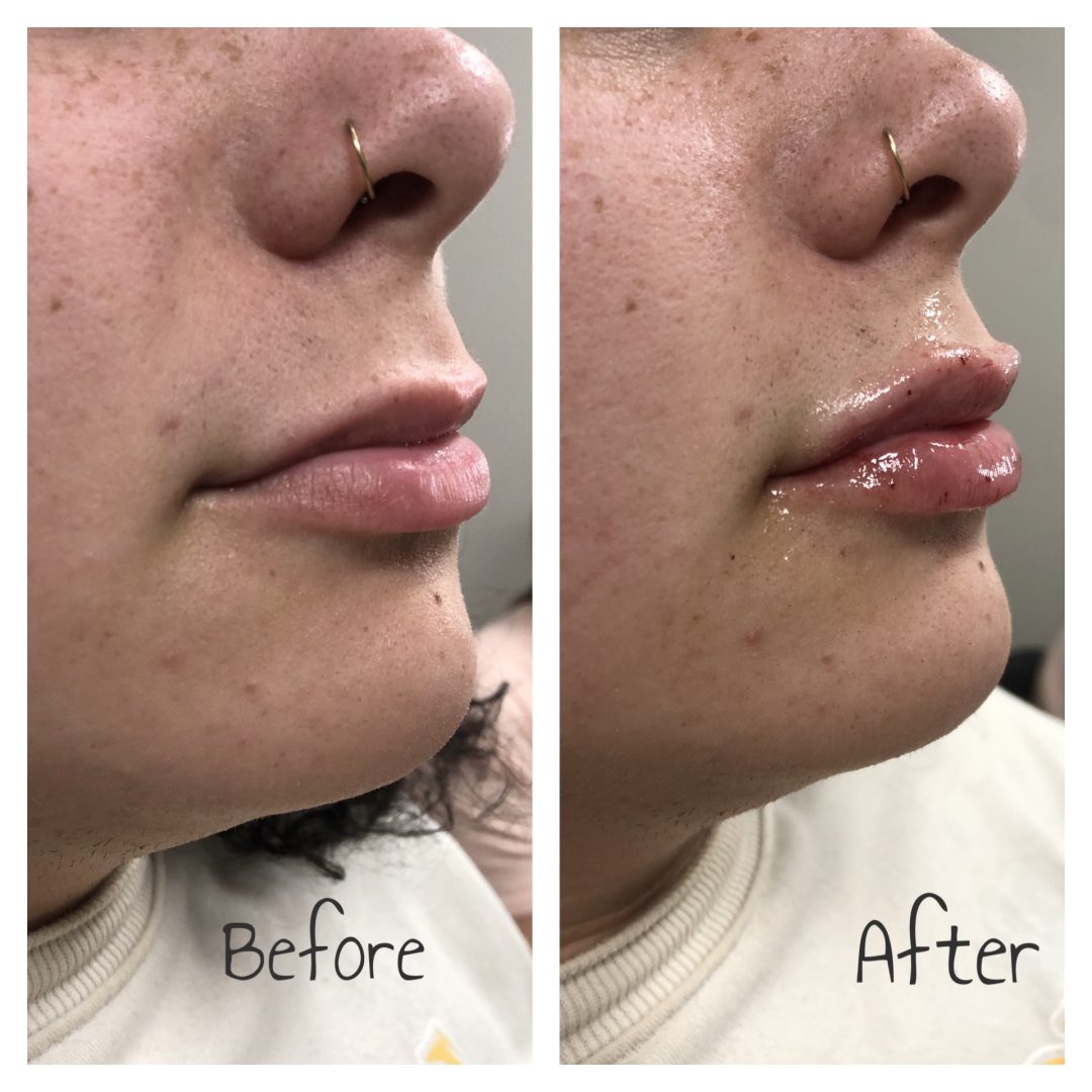 Juvederm Volbella lip filler