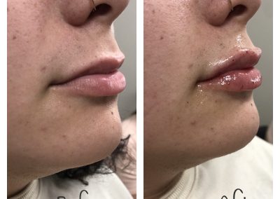 Juvederm Volbella lip filler