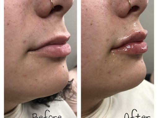 Juvederm Volbella lip filler