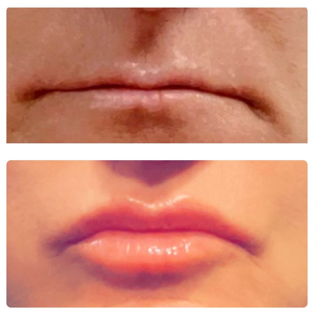 1mL Vobella Lip Filler