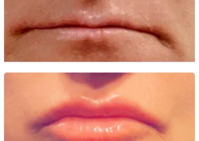 1mL Vobella Lip Filler