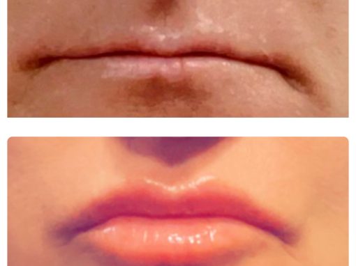 1mL Vobella Lip Filler