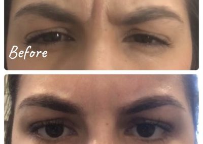 Glabella and corrigator muscles treatment