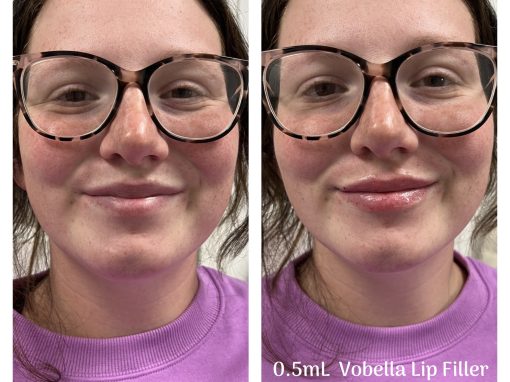 0.5ml Vobella Lip Filler